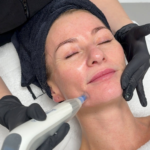Microneedling